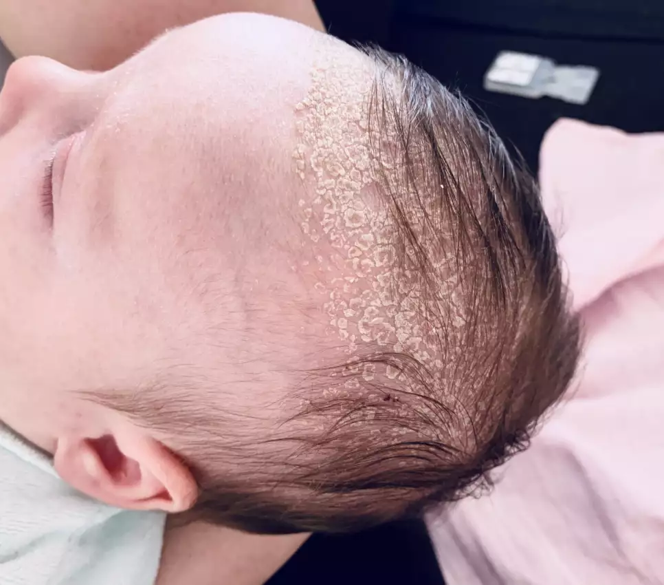 Kopfgneis und Milchschorf