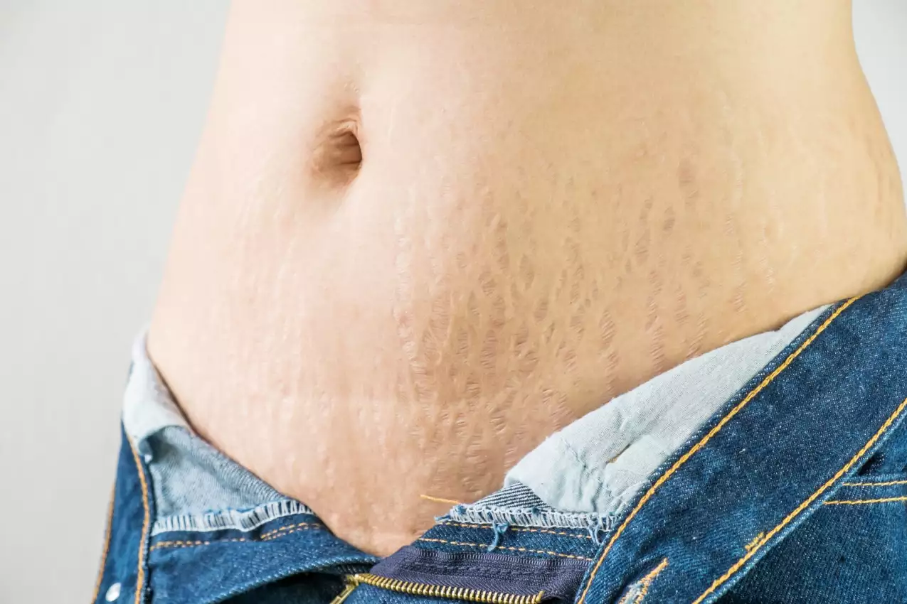 Schwangerschaftsstreifen