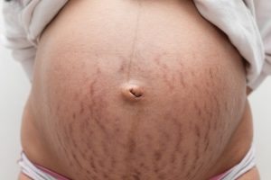 Striae gravidarum – Tipps bei Schwangerschaftsstreifen