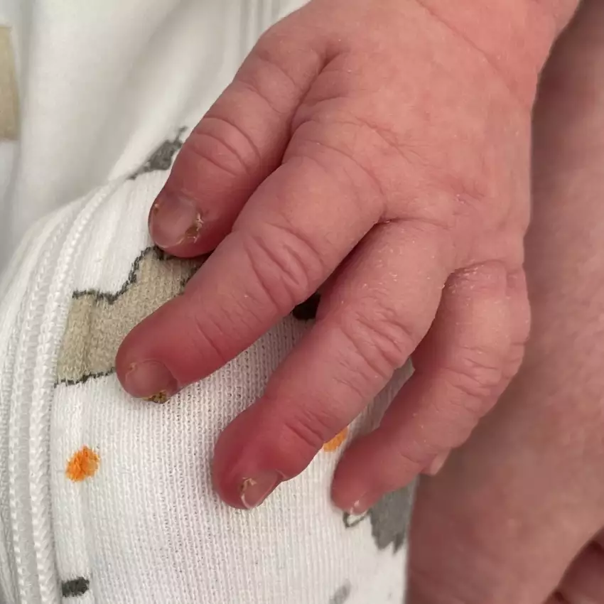 Nagelbettentzündungen