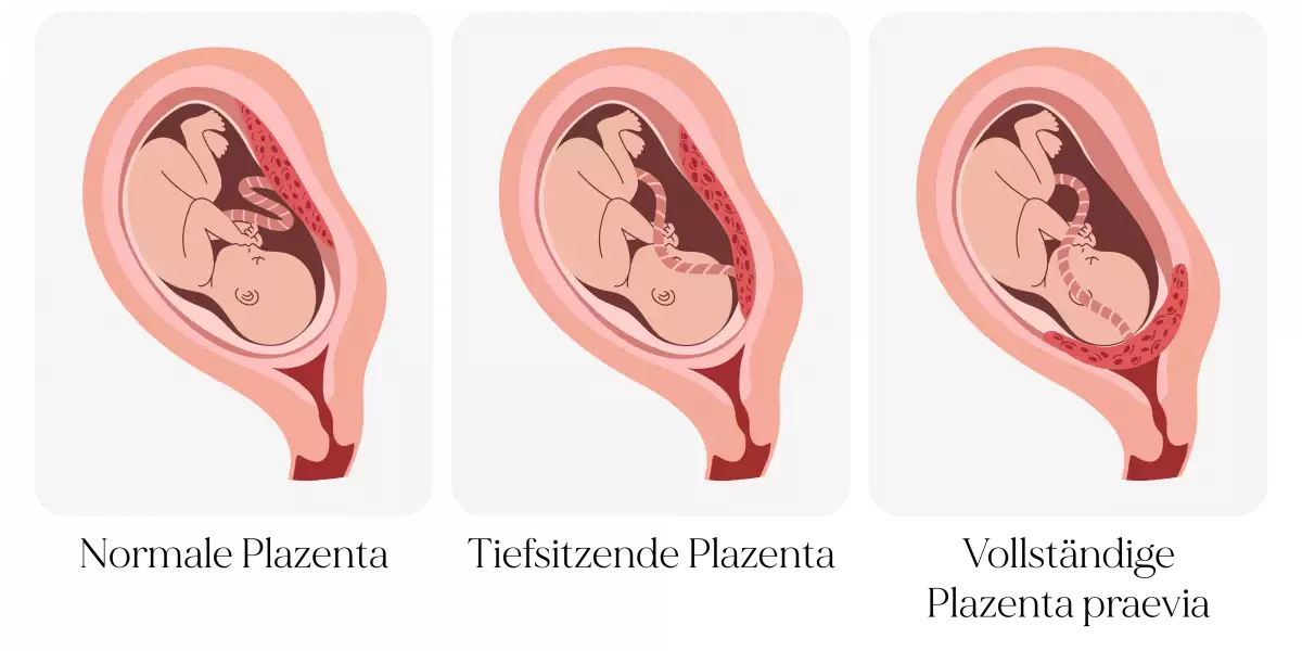 Plazenta praevia - Diagnose, Behandlung & Geburt